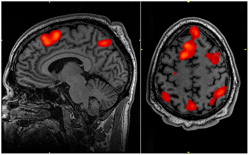 Photo ID: An image of a brain scan with parts of the brain highlighted in red
